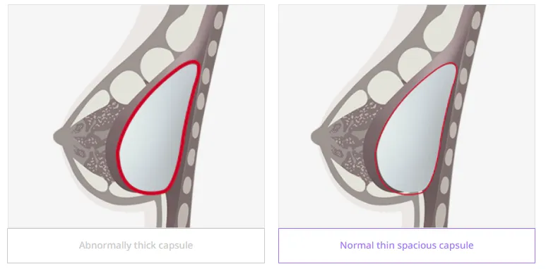 Illustration comparing capsular contracture with an abnormally thick capsule around a breast implant versus a normal thin spacious capsule.