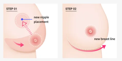 Illustration of breast reduction surgery steps showing new nipple placement and creation of a lifted breast line.