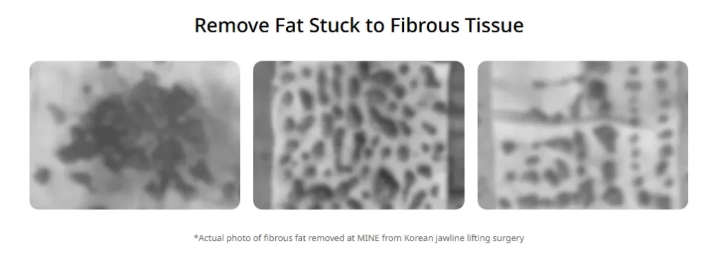 Actual surgical photo from Korean jawline lifting showing removal of fibrous fat tissue; mini neck lift technique helps improve jawline contour and reduce sagging.