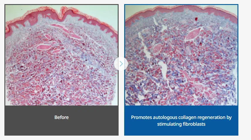 Skin tissue histology before and after juvelook volume treatment showing fibroblast stimulation and collagen regeneration.
