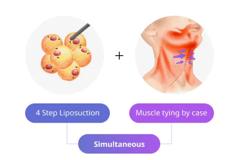 Medical illustration showing Korean jawline improvement through a combination of 4-step liposuction and customized muscle tying, performed simultaneously for a slimmer and more defined contour.