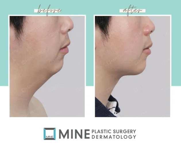 Before and after results of Korean jawline surgery at Mine Plastic Surgery, showing a slimmer chin and improved neck contour.