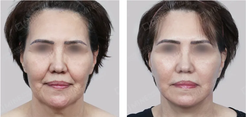 Front-view before and after photos of a facelift patient showing smoother nasolabial folds, lifted cheeks, and a more defined jawline.
