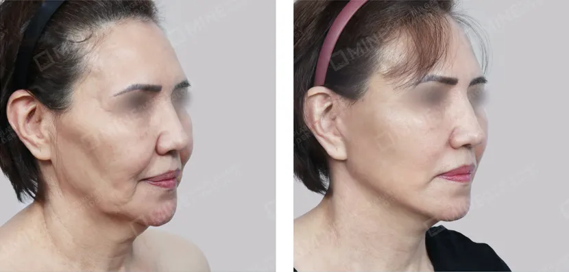 Side view before and after results of a deep plane facelift in a middle-aged woman, highlighting lifted jowls, tightened neckline, and rejuvenated midface profile.