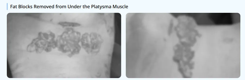 Fat blocks removed from under the platysma muscle during Korean jawline lifting surgery; mini neck lift enhances jawline contour and corrects sagging.