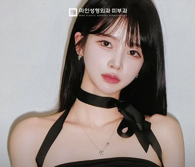 Young woman with slim neckline and elegant shoulder line after trapezius botox treatment, showcasing refined collarbone and natural V-line effect.