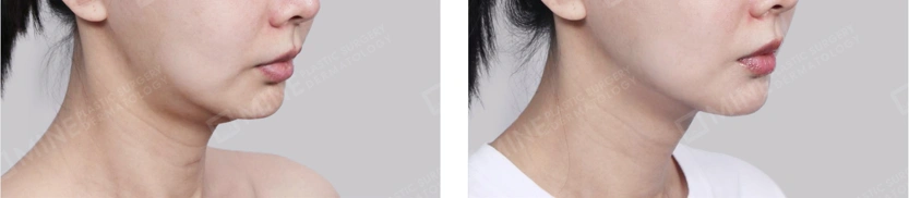 Salivary gland reduction before and after results showing improved jawline contour and smoother neck profile.