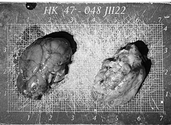 Salivary gland reduction specimen image showing removed salivary gland tissues for medical reference.
