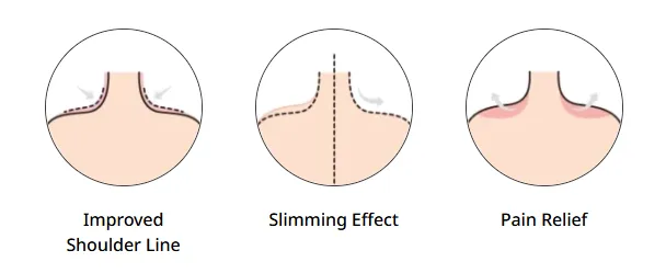 Illustration of trapezius botox benefits showing an improved shoulder line, slimming effect, and pain relief.