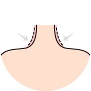 Illustration showing trapezius botox injection areas along the upper shoulder, demonstrating reduction of bulky trapezius muscle for a smoother shoulder slope.