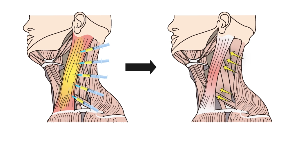 Medical illustration showing trapezius botox injection points along the neck and upper shoulder muscles, demonstrating targeted muscle relaxation of the trapezius.