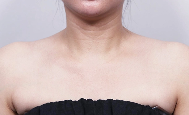 After image showing reduced shoulder bulk and a smoother neckline following trapezius botox treatment.