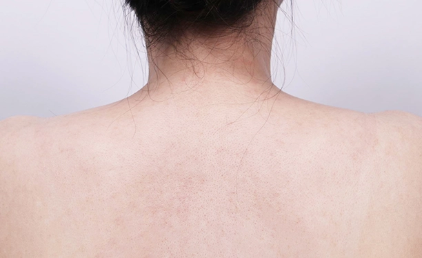 After image showing a smoother upper back and refined trapezius line following trapezius botox treatment.