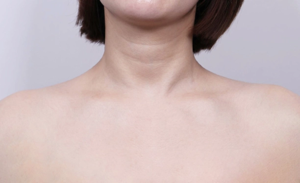 After image demonstrating softened shoulder slope and improved neck definition after trapezius botox treatment.