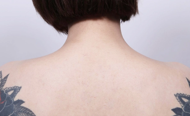 Back view after trapezius botox, demonstrating softened trapezius muscle and a longer-looking neck line.