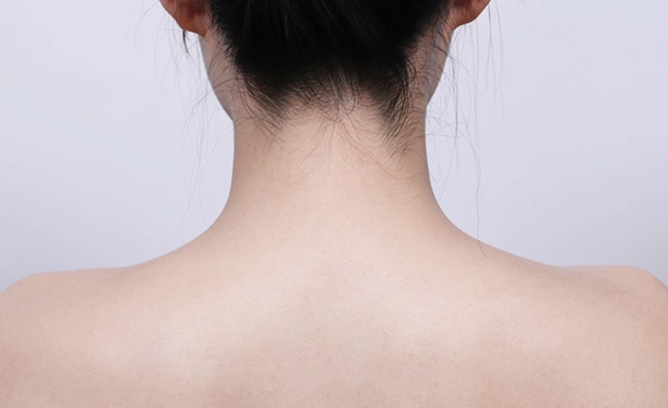 After image showing relaxed trapezius muscles and improved neck definition after trapezius botox treatment.