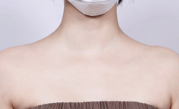 After image showing a slimmer neck and refined shoulder line achieved with trapezius botox treatment.