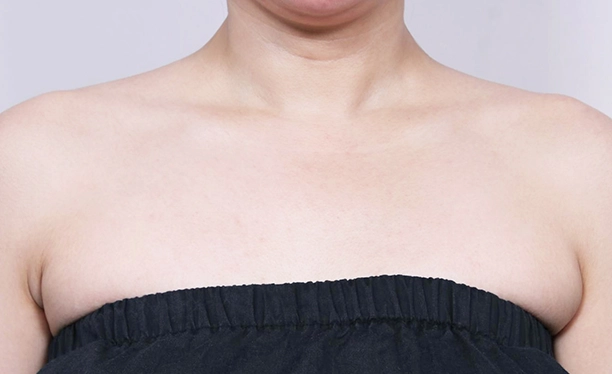 After image showing reduced trapezius muscle bulk and a smoother shoulder contour following trapezius botox.