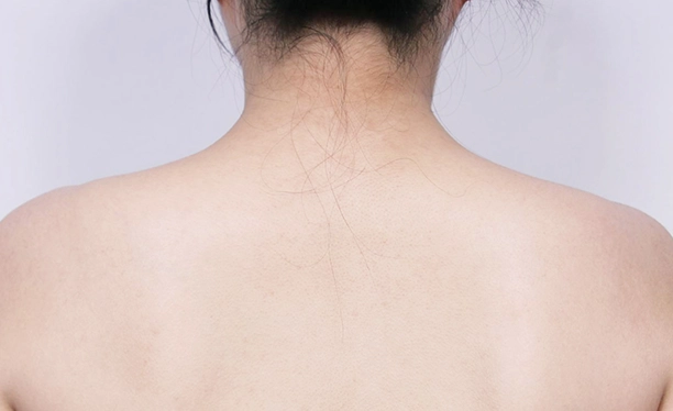 After image showing reduced trapezius muscle prominence and a smoother upper back contour following trapezius botox.