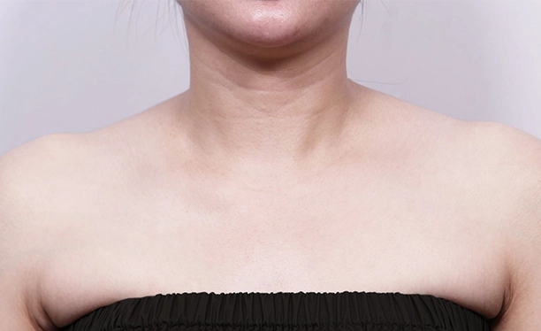Before image showing prominent trapezius muscle and fuller shoulder line prior to trapezius botox treatment.