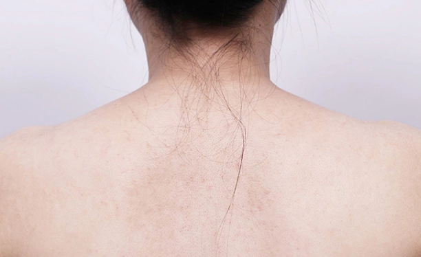 Before image showing uneven trapezius muscle contour and visible bulk along the upper back prior to trapezius botox.