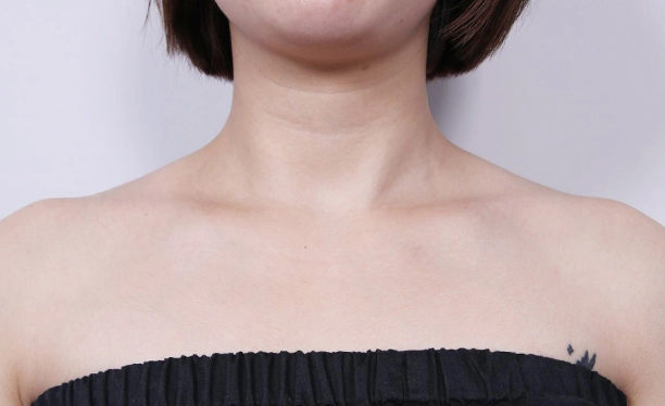 Before image highlighting visible trapezius muscle tension and less-defined neck-to-shoulder contour before trapezius botox.