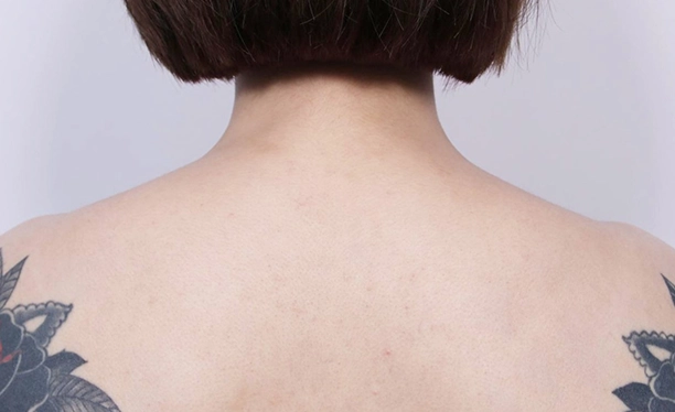 Back view before trapezius botox, showing thicker upper trapezius muscle and less-defined neck-to-shoulder transition.