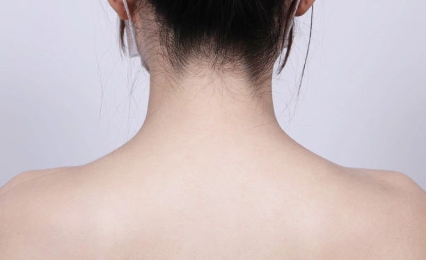 Before image highlighting muscle tension and fullness in the trapezius area contributing to a shorter neck appearance before trapezius botox.
