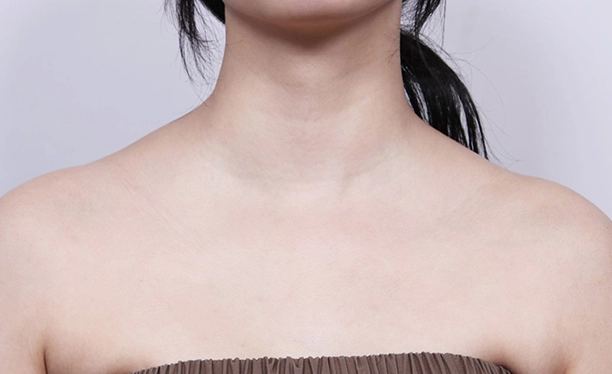 Before image showing thicker trapezius muscle appearance contributing to a shorter-looking neck prior to trapezius botox.
