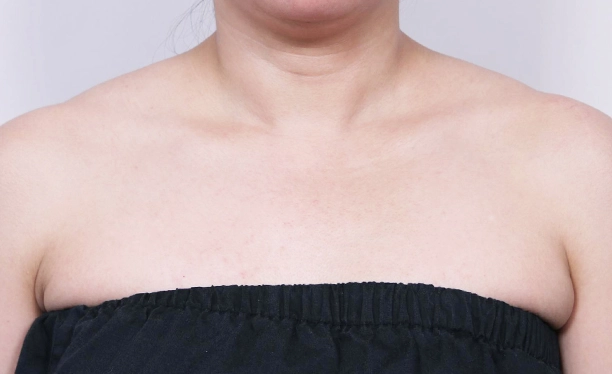 Before image showing prominent trapezius muscle and broader shoulder line prior to trapezius botox treatment.