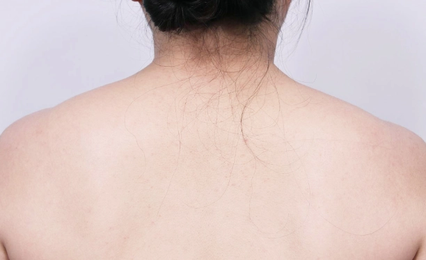 Before image showing visible upper back trapezius muscle bulk and a broader shoulder slope prior to trapezius botox treatment.