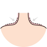Diagram illustrating trapezius botox injection along the upper shoulder muscle, showing reduction of bulky trapezius muscle for a smoother neckline.