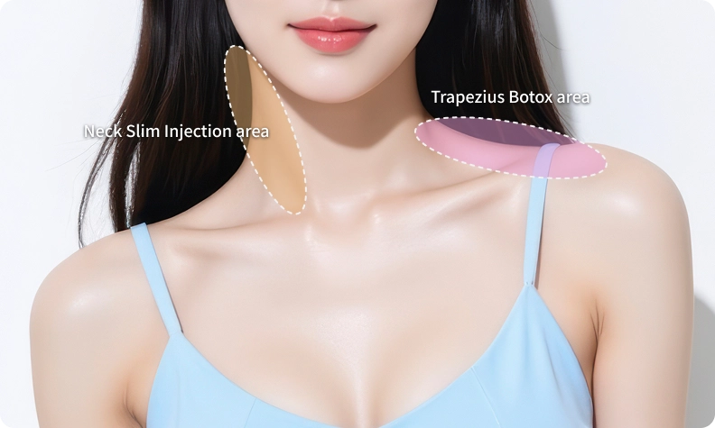 Close-up illustration of neck and shoulder anatomy highlighting injection zones, showing the trapezius botox area and neck slimming injection area for refined shoulder contour and a slimmer neckline.