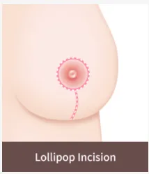 Medical illustration showing the lollipop incision method used in breast lift surgery, featuring a circular incision around the areola with a vertical line down to the breast crease for reshaping and lifting sagging breasts.