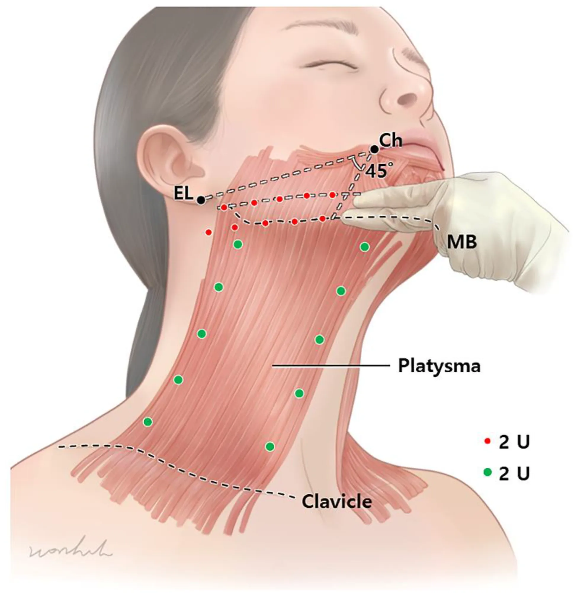 Platysmal bands anatomy: the platysma neck muscle that separates and forms vertical cords treated by platysmaplasty