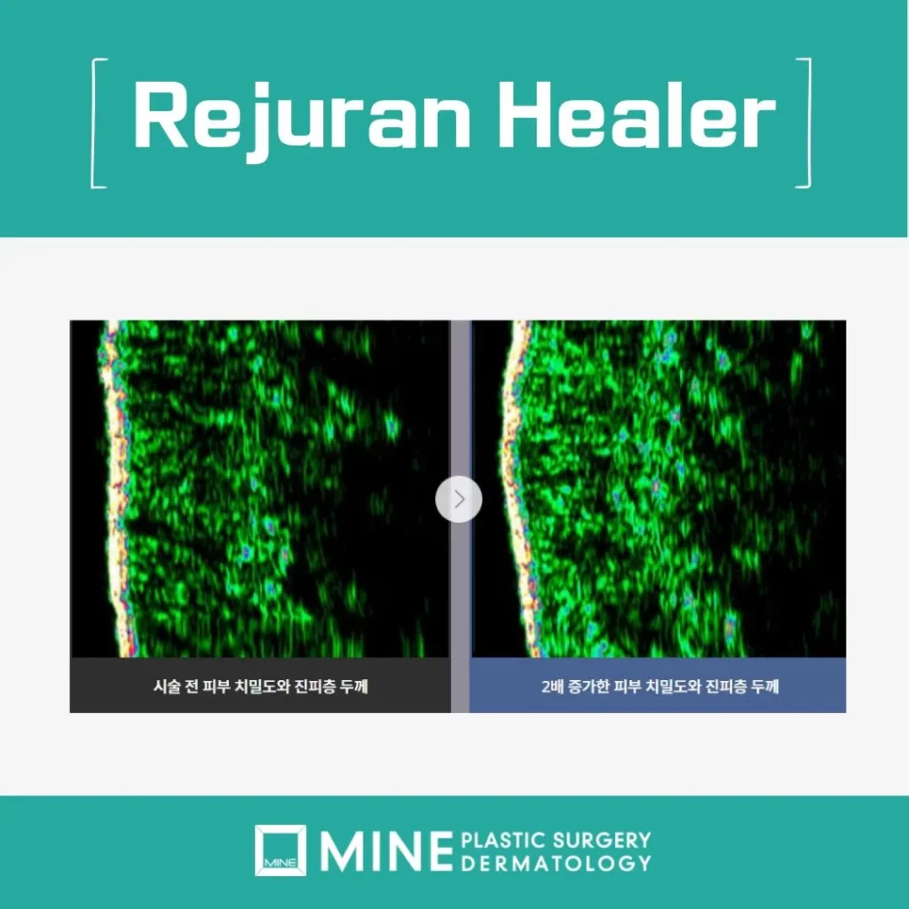Before and after skin ultrasound images showing increased dermal density and thickness after Juvelook and Rejuran treatments.