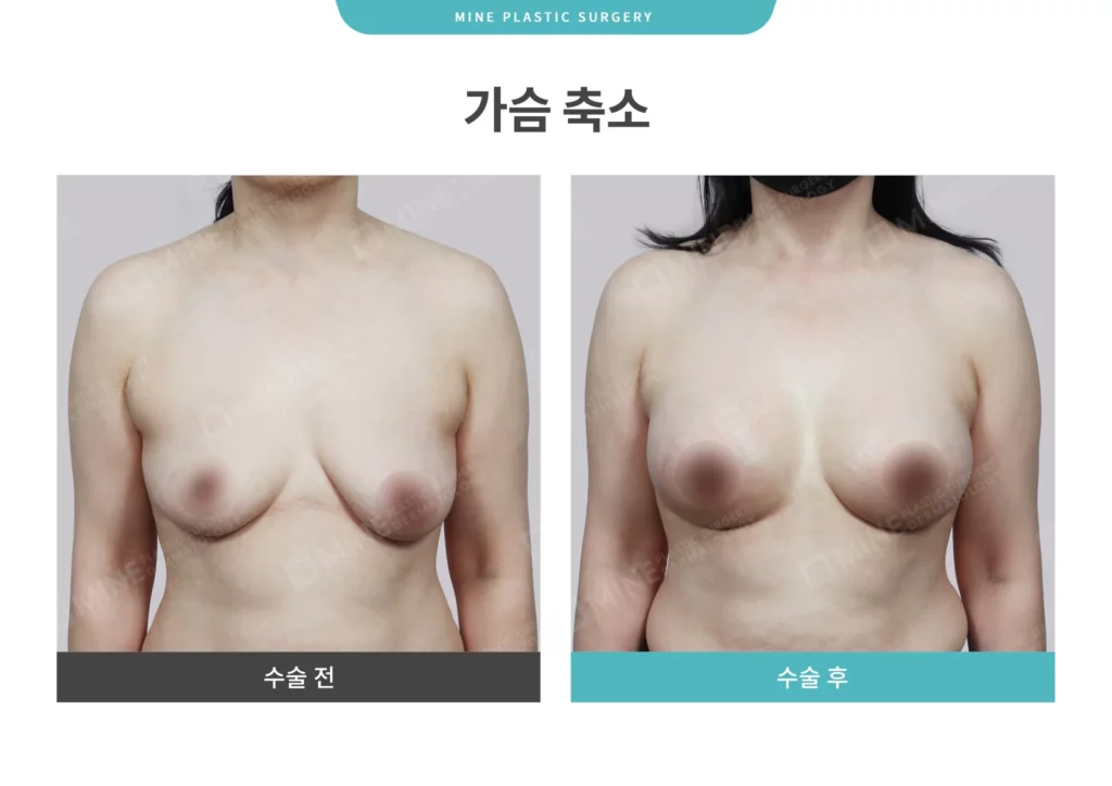 Korean breast lift and breast augmentation results demonstrating enhanced breast contour, corrected sagging, and fuller, more symmetrical volume after surgery.