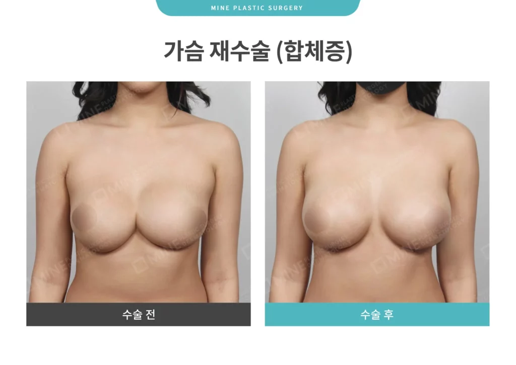 Korean breast revision surgery before and after comparison showing improvement of breast asymmetry and implant-related issues, with front-view images of the patient demonstrating more balanced and natural results after correction.