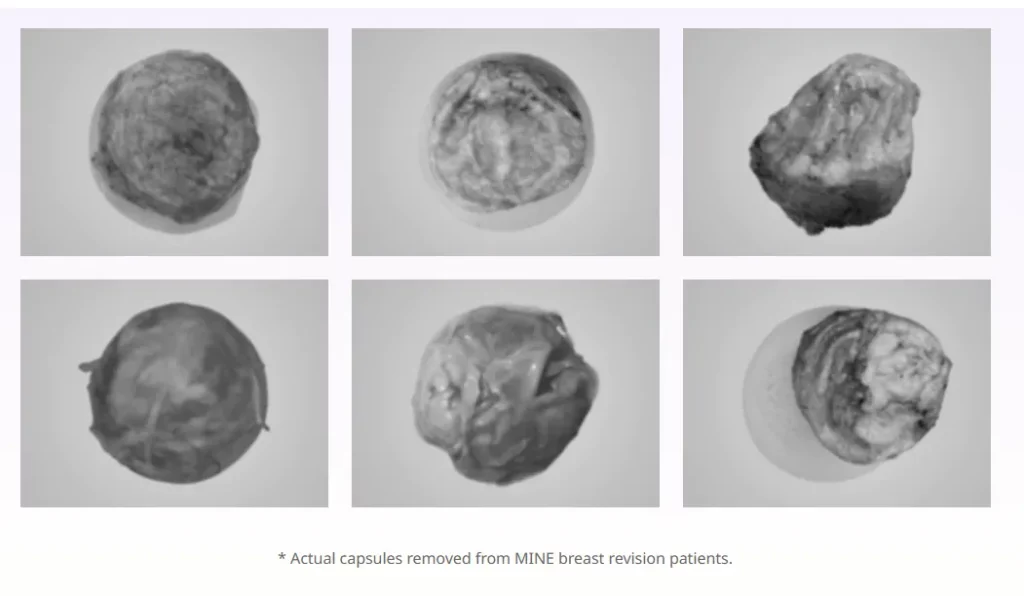 Korean breast revision surgery capsule samples displayed in a 2x3 grid, showing actual removed breast implant capsules with varying textures and shapes.