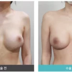 Before and after breast surgery showing improved breast shape after treating capsular contracture, performed at a professional plastic surgery clinic.