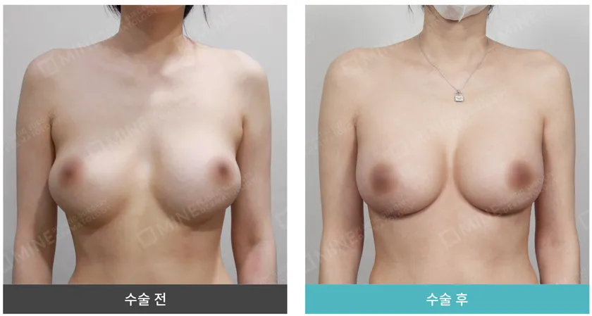 Before and after breast surgery showing improved breast shape after treating capsular contracture, performed at a professional plastic surgery clinic.
