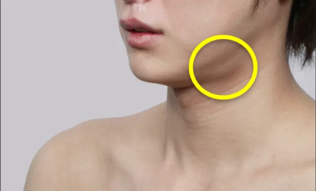 Close-up of a person’s lower face and neck showing a visible bulge under the jawline, highlighted with a yellow circle, illustrating the target area for salivary gland reduction treatment.