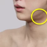 Close-up of a person’s lower face and neck showing a visible bulge under the jawline, highlighted with a yellow circle, illustrating the target area for salivary gland reduction treatment.