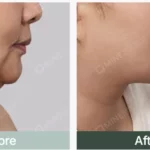 Before and after comparison showing improvement of a double chin after cosmetic treatment, highlighting a slimmer and more defined jawline.