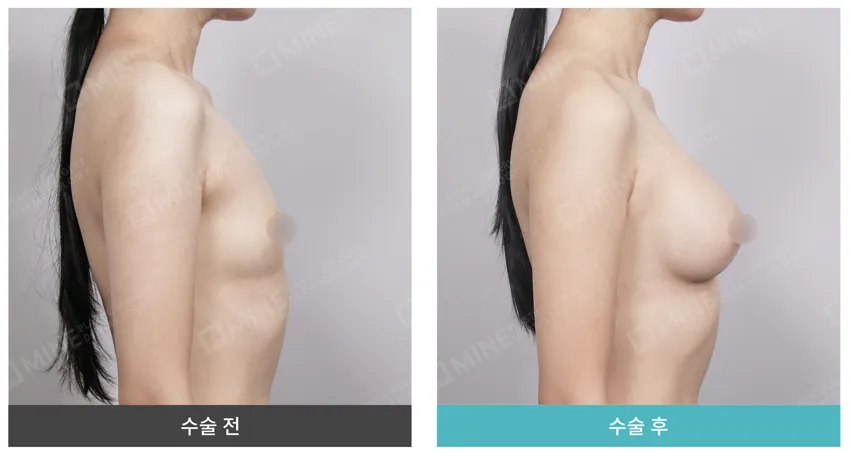 Breast augmentation at MINE Clinic Korea — post-surgical hardness and firmness after implant placement is a normal part of recovery that gradually softens over months.