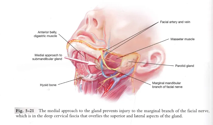 An anatomical illustration showing the medial surgical approach for salivary gland reduction at the submandibular region, labeling key structures such as the anterior belly of the digastric muscle, facial artery and vein, masseter muscle, parotid gland, hyoid bone, and the marginal mandibular branch of the facial nerve.