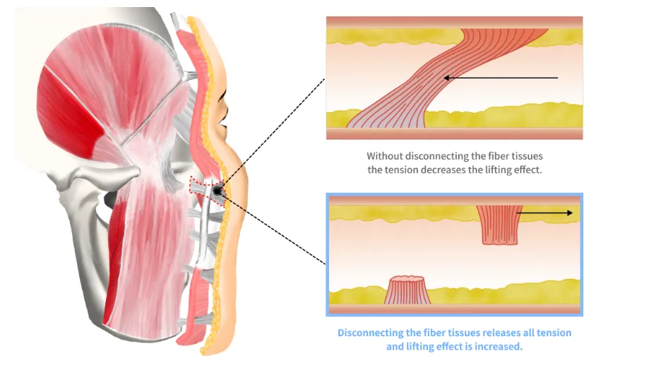 Anatomical illustration showing the lifting mechanism in a mini facelift. The diagram compares tension with and without fiber tissue disconnection, demonstrating how releasing connective fibers enhances the lifting effect and skin tightening.