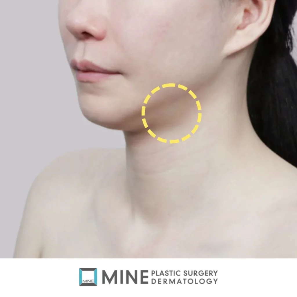 Close-up image of a woman’s lower face and neck with a yellow dashed circle highlighting the submandibular area, illustrating the target region for salivary gland reduction to improve jawline definition.