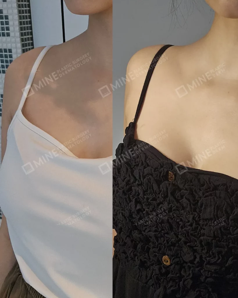 Trapezius Botox result comparison image showing shoulder contour improvement and reduced muscle bulk, photographed in natural indoor lighting with white and black sleeveless tops.