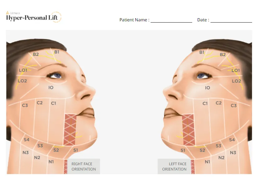 Ulthera treatment mapping diagram showing right and left face orientation with labeled zones for personalized lifting.